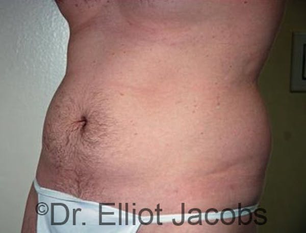 Torsoplasty Before & After Gallery - Patient 120163592 - Image 3