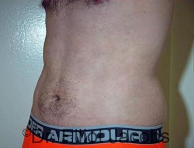 Torsoplasty Before & After Gallery - Patient 120163592 - Image 4