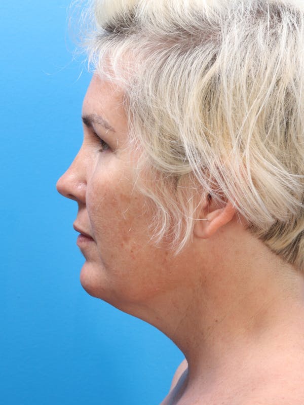 MyEllevate™ Before & After Gallery - Patient 120353925 - Image 3