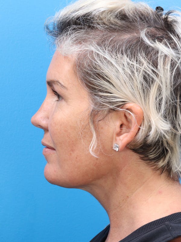 MyEllevate™ Before & After Gallery - Patient 120353925 - Image 4