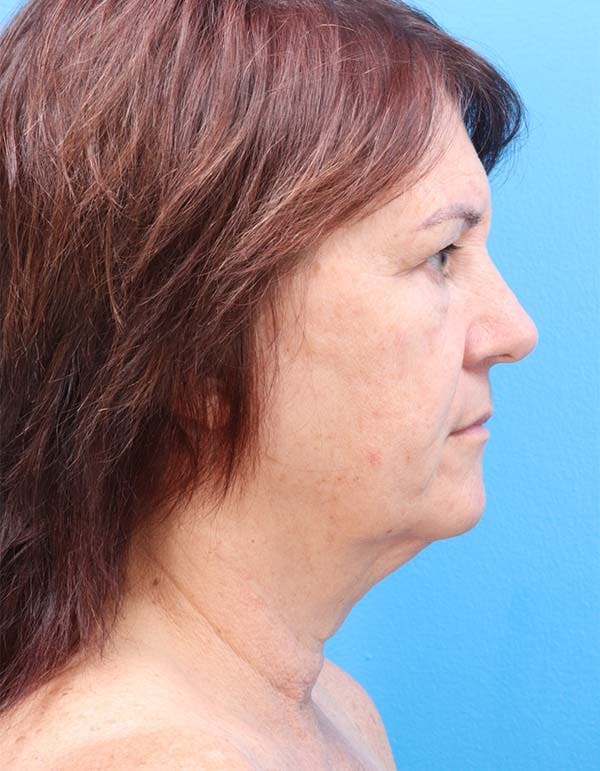 Facelift Before & After Gallery - Patient 122160709 - Image 3