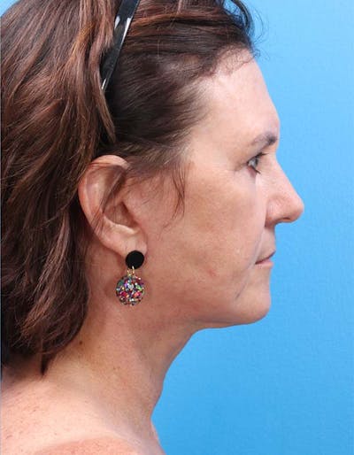 Facelift Before & After Gallery - Patient 122160709 - Image 4