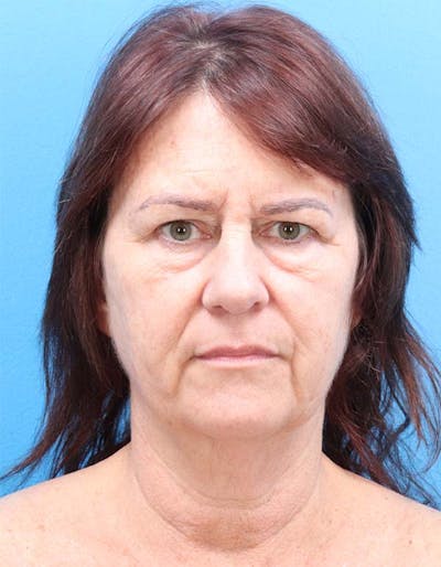 Facelift Before & After Gallery - Patient 122160709 - Image 1