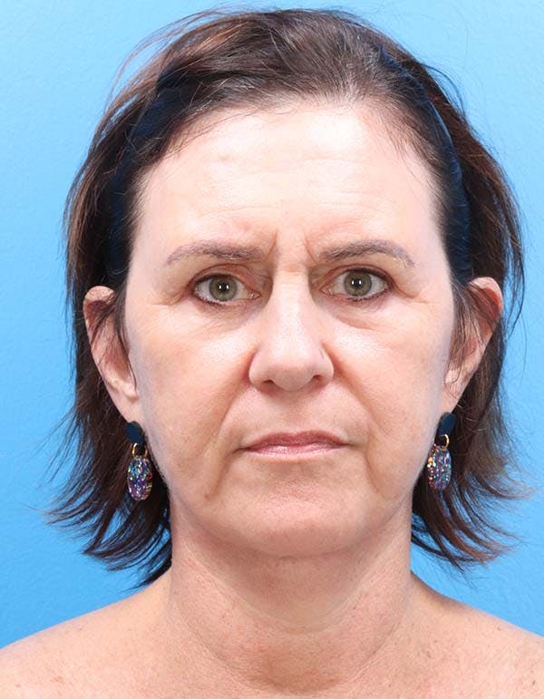 Facelift Before & After Gallery - Patient 122160709 - Image 2