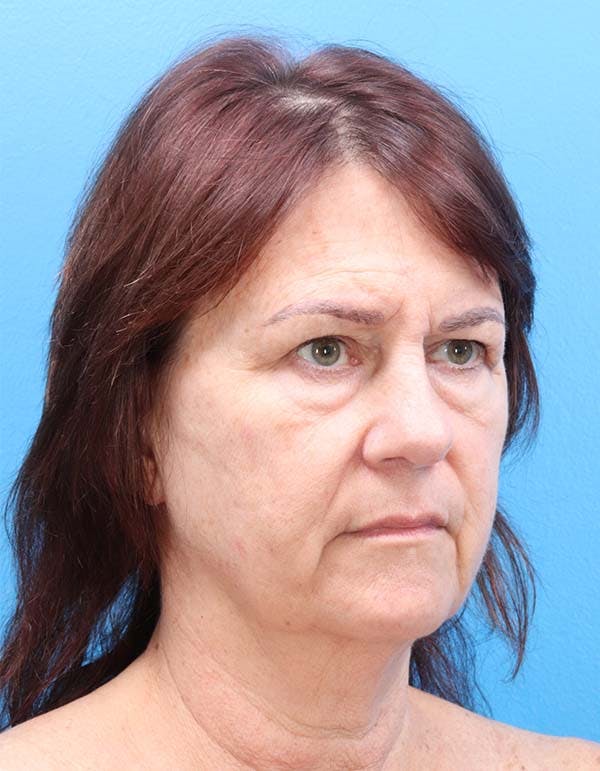 Facelift Before & After Gallery - Patient 122160709 - Image 5