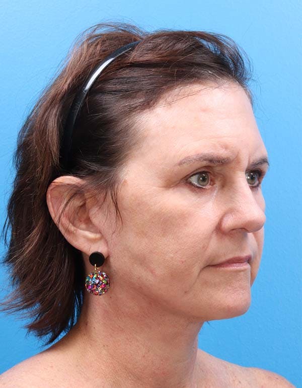 Neck Lift Before & After Gallery - Patient 122160710 - Image 2