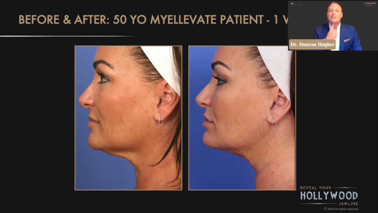 MyEllavate Before & After