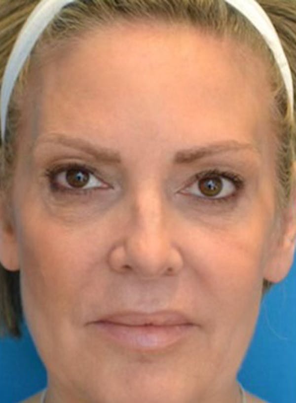 Mini-Facelift Before & After Gallery - Patient 123039409 - Image 1