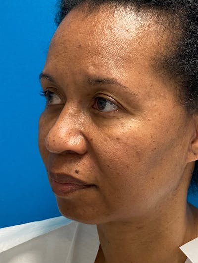 Septoplasty Before & After Gallery - Patient 123039551 - Image 1