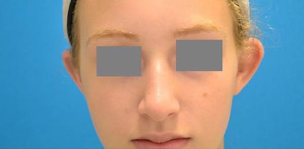 Otoplasty Before & After Gallery - Patient 123039496 - Image 1