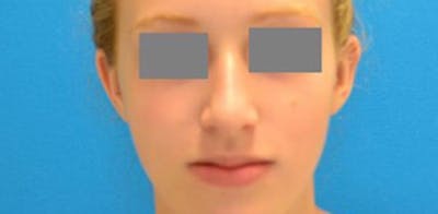 Otoplasty Before & After Gallery - Patient 123039496 - Image 2