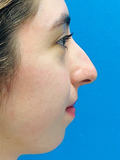 Rhinoplasty Before & After Gallery - Patient 123039564 - Image 1