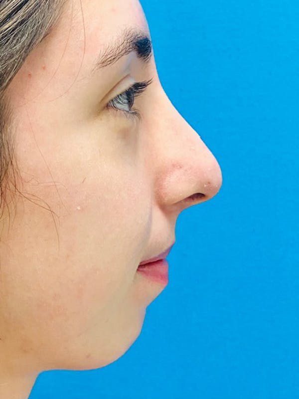 Rhinoplasty Before & After Gallery - Patient 123039564 - Image 2