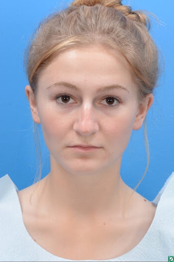 Rhinoplasty Before & After Gallery - Patient 129393893 - Image 1