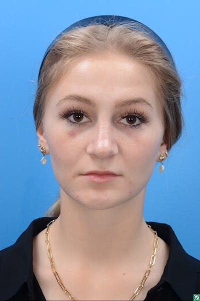 Rhinoplasty Before & After Gallery - Patient 129393893 - Image 2