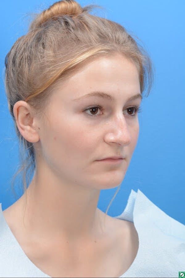 Rhinoplasty Before & After Gallery - Patient 129393893 - Image 3