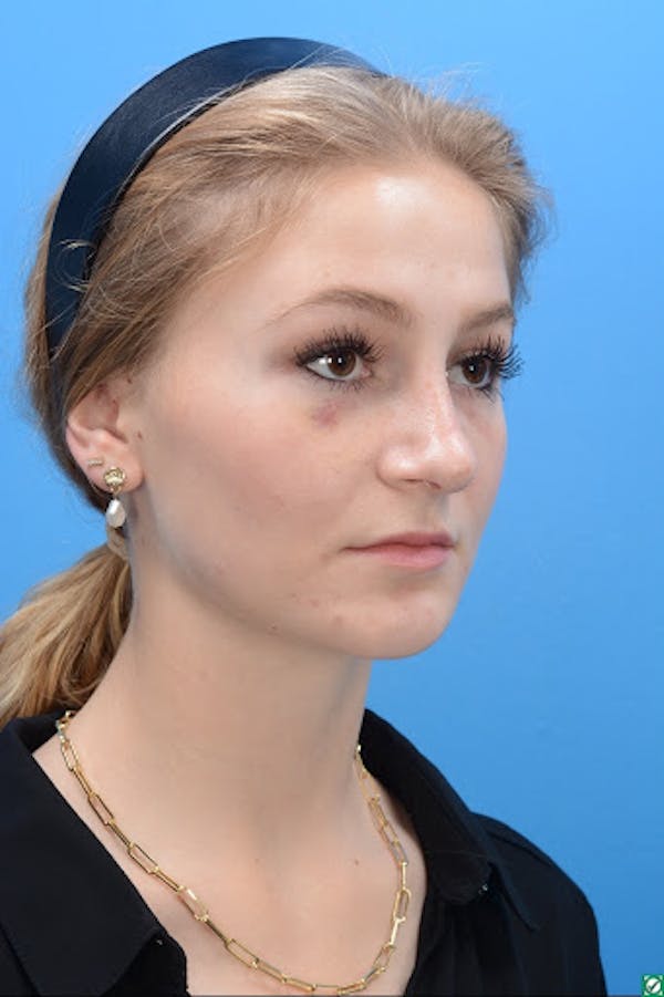 Rhinoplasty Before & After Gallery - Patient 129393893 - Image 4