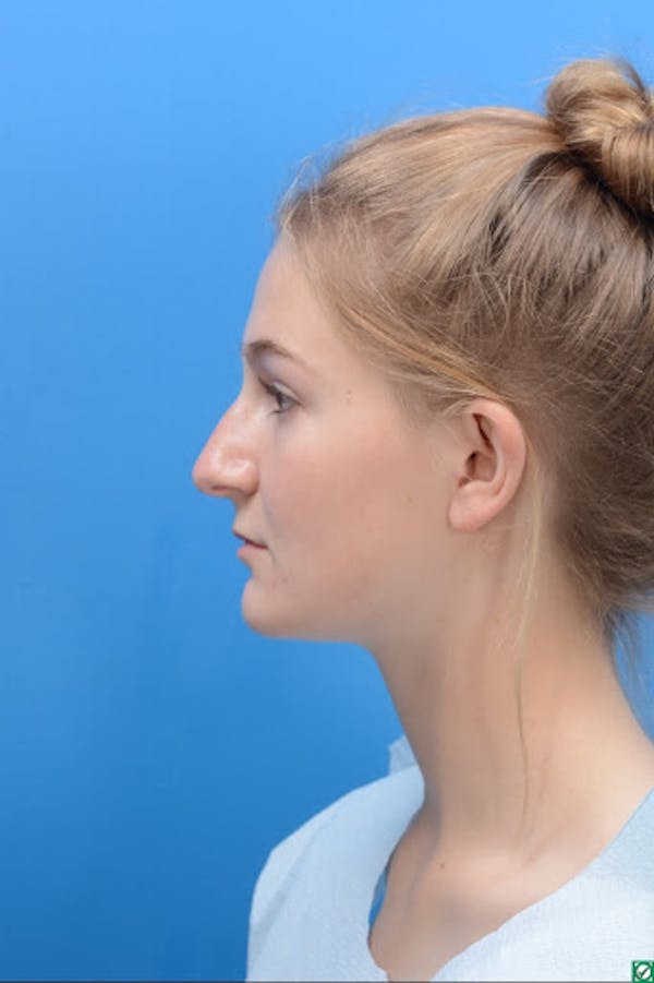 Rhinoplasty Before & After Gallery - Patient 129393893 - Image 5