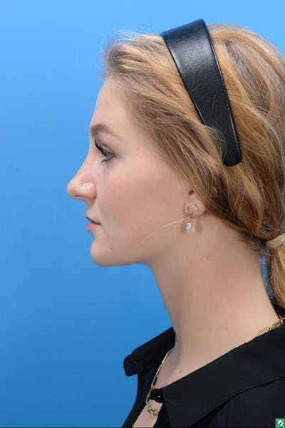 Rhinoplasty Before & After Gallery - Patient 129393893 - Image 6