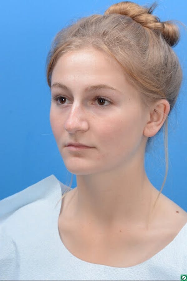 Rhinoplasty Before & After Gallery - Patient 129393893 - Image 7