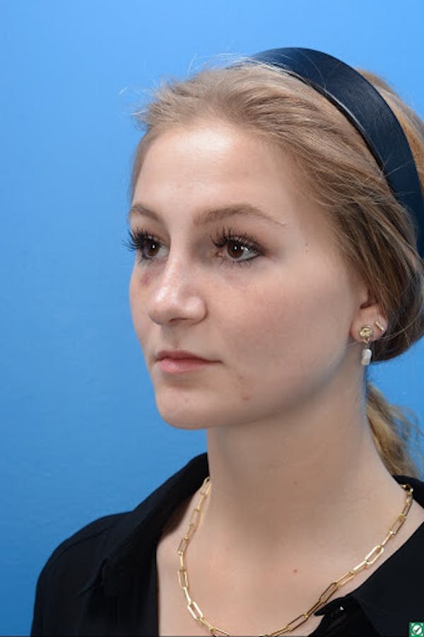 Rhinoplasty Before & After Gallery - Patient 129393893 - Image 8