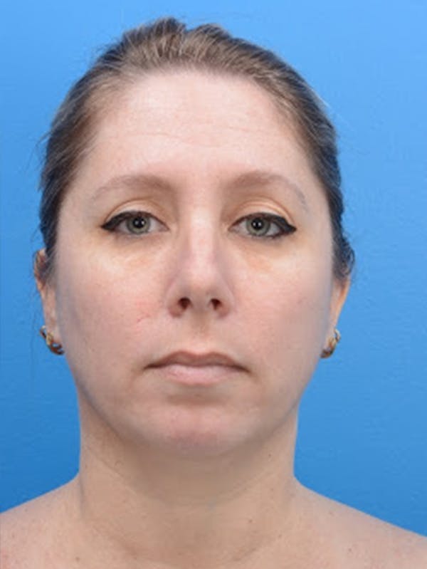 Rhinoplasty Before & After Gallery - Patient 129393951 - Image 1
