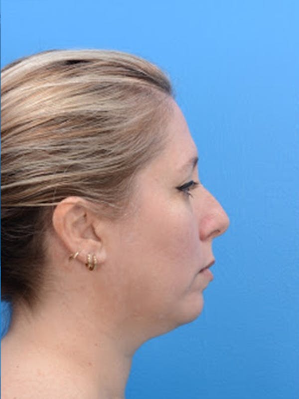 Rhinoplasty Before & After Gallery - Patient 129393951 - Image 3