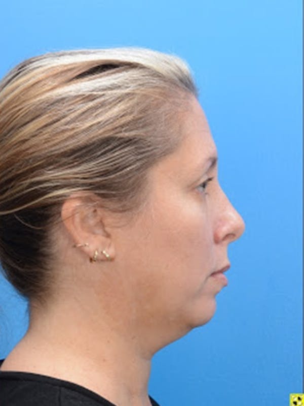 Rhinoplasty Before & After Gallery - Patient 129393951 - Image 4
