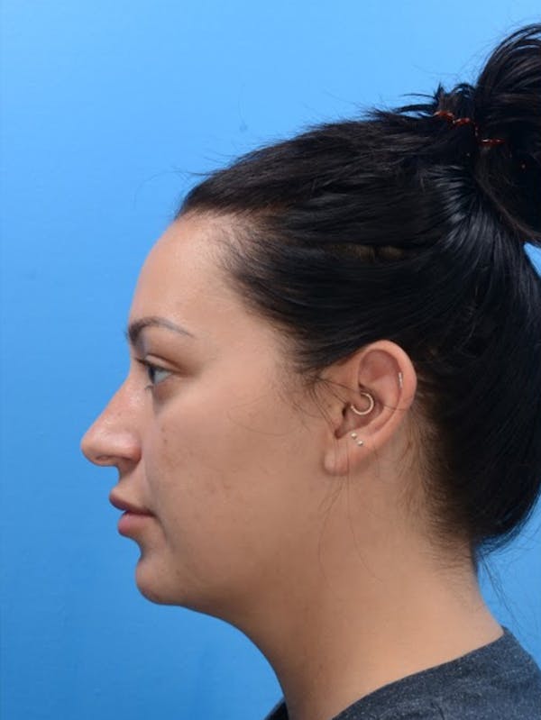 Rhinoplasty Before & After Gallery - Patient 129394056 - Image 3