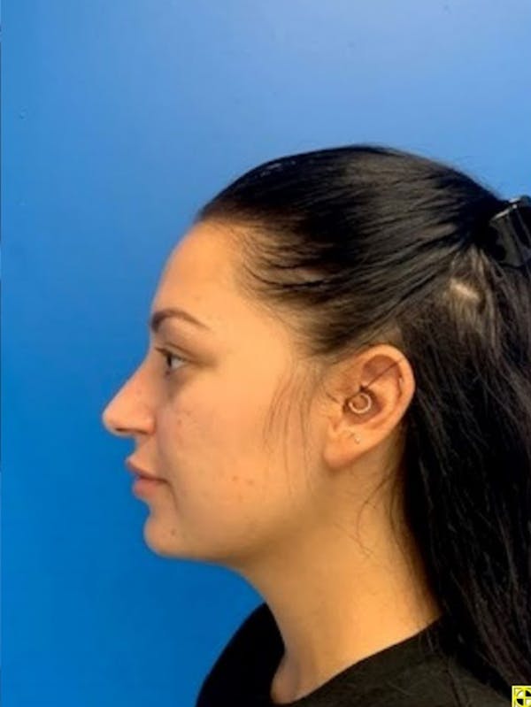 Rhinoplasty Before & After Gallery - Patient 129394056 - Image 4
