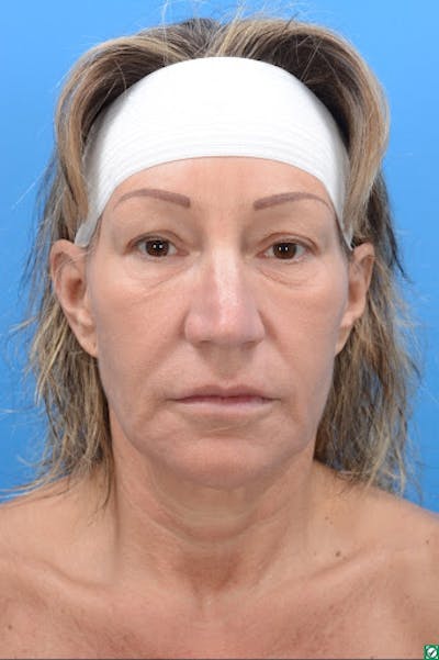 Rhinoplasty Before & After Gallery - Patient 129394214 - Image 1