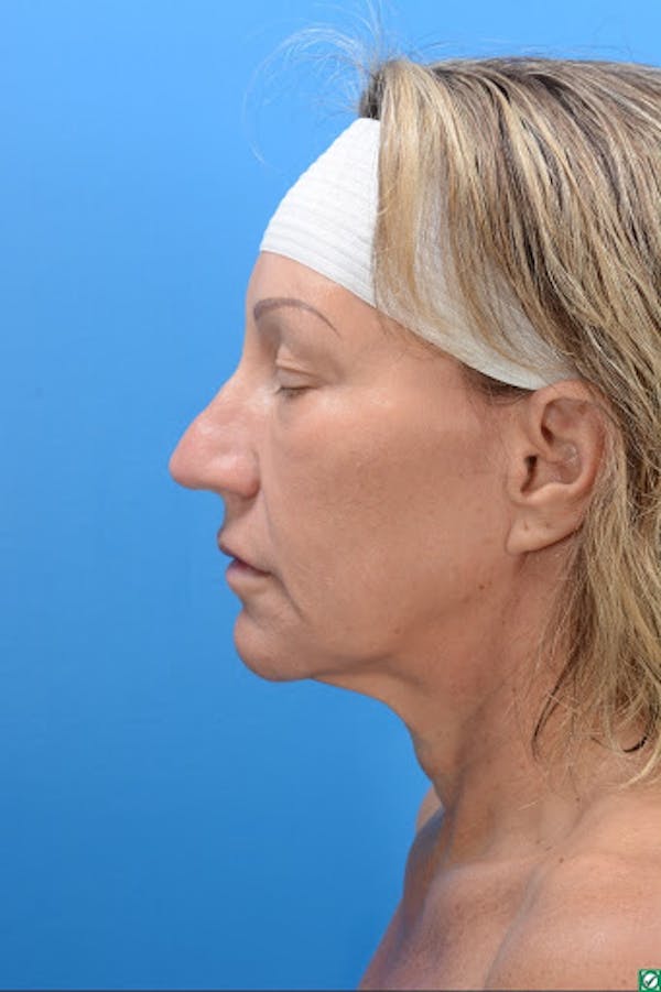 Rhinoplasty Before & After Gallery - Patient 129394214 - Image 3