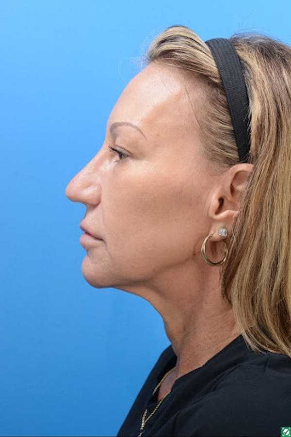 Rhinoplasty Before & After Gallery - Patient 129394214 - Image 4