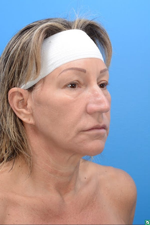 Rhinoplasty Before & After Gallery - Patient 129394214 - Image 5
