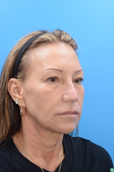 Rhinoplasty Before & After Gallery - Patient 129394214 - Image 6