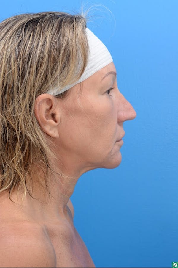 Rhinoplasty Before & After Gallery - Patient 129394214 - Image 7