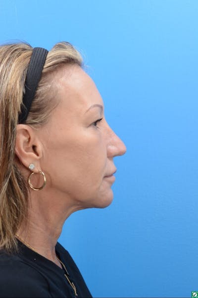 Rhinoplasty Before & After Gallery - Patient 129394214 - Image 8