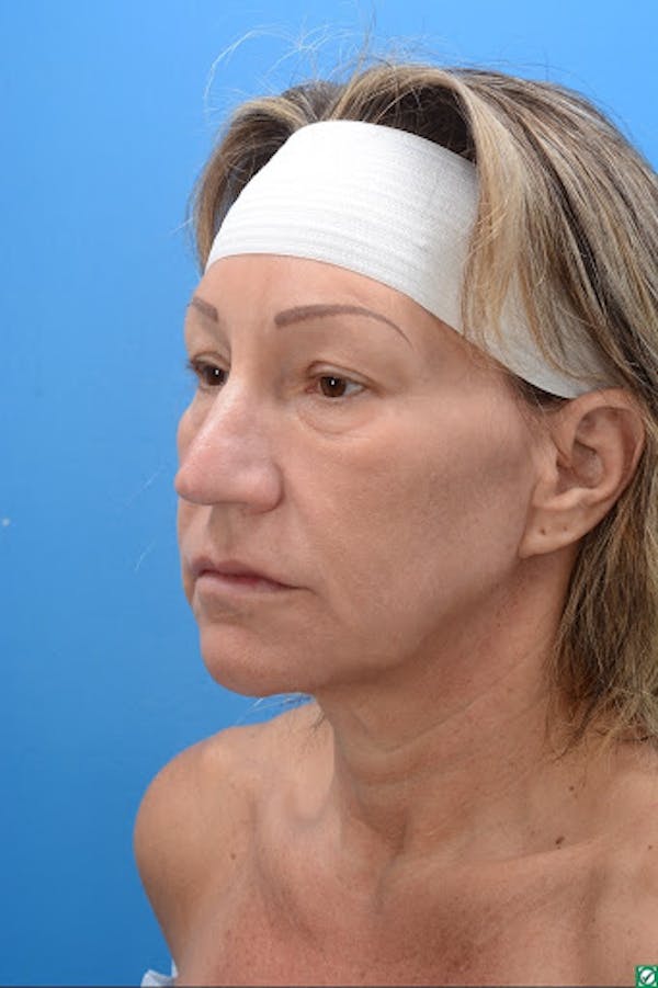 Rhinoplasty Before & After Gallery - Patient 129394214 - Image 9