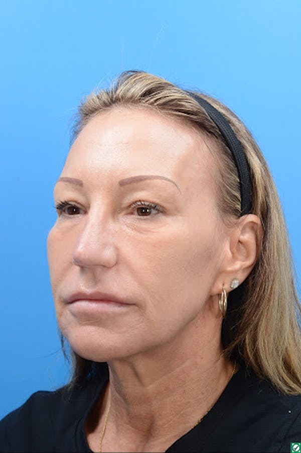 Rhinoplasty Before & After Gallery - Patient 129394214 - Image 10