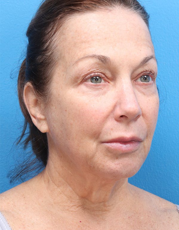 MyEllevate™ Before & After Gallery - Patient 129440096 - Image 3