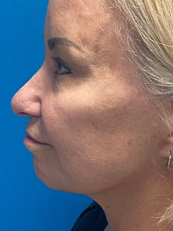 Neck Lift Before & After Gallery - Patient 129443395 - Image 1