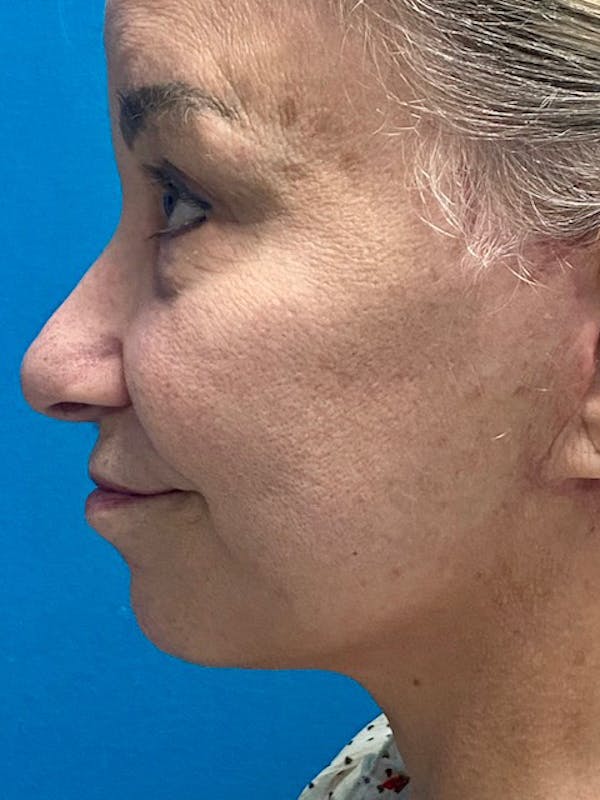 Neck Lift Before & After Gallery - Patient 129443395 - Image 2