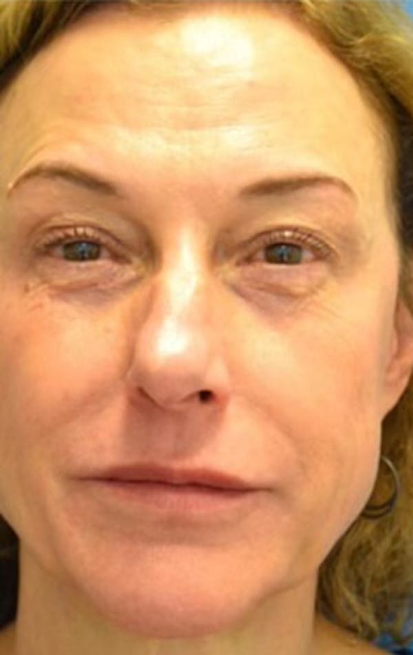 Facelift Before & After Gallery - Patient 129444004 - Image 1