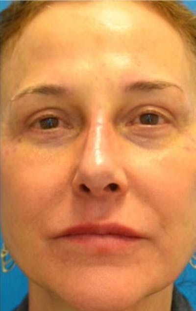 Facelift Before & After Gallery - Patient 129444004 - Image 2