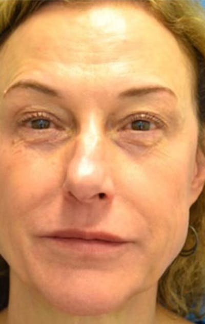 Blepharoplasty Before & After Gallery - Patient 129444187 - Image 1