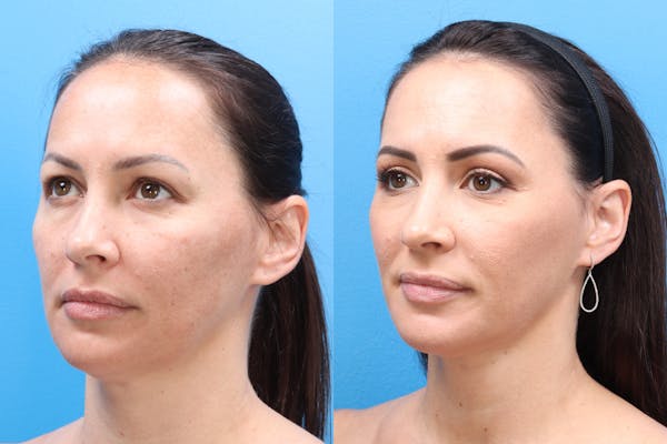 Blepharoplasty Before & After Gallery - Patient 140841189 - Image 2