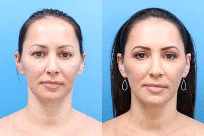 Blepharoplasty Before & After Gallery - Patient 140841189 - Image 1