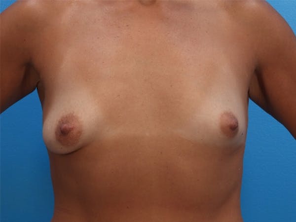 Breast Augmentation Before & After Gallery - Patient 143651051 - Image 1