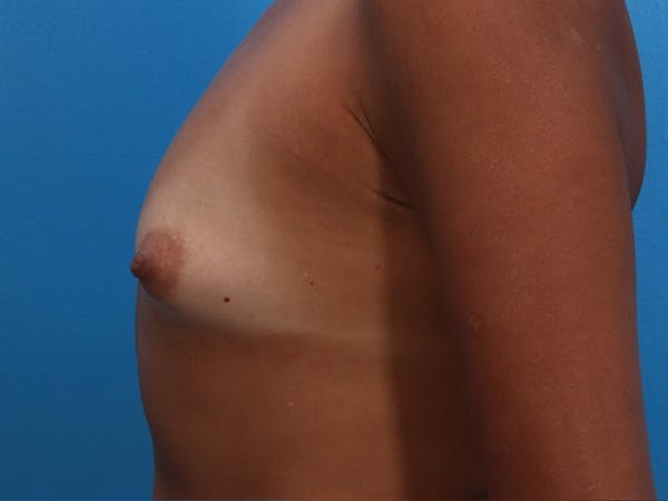Breast Augmentation Before & After Gallery - Patient 143651051 - Image 9