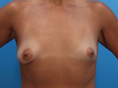 Breast Lift Before & After Gallery - Patient 143775495 - Image 1